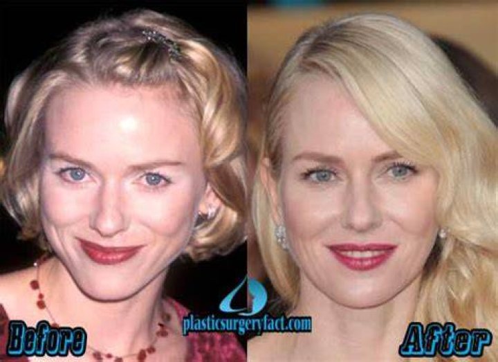 Naomi Watts Plastic Surgery Before and After