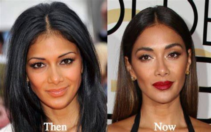 Nicole Scherzinger Plastic Surgery Before and After